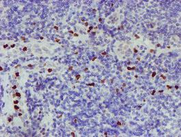 PADI4 / PAD4 Antibody - IHC of paraffin-embedded Human lymphoma tissue using anti-PADI4 mouse monoclonal antibody.