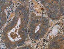 PAEP / Glycodelin / GdF Antibody - Immunohistochemistry of paraffin-embedded Human colon cancer using PAEP Polyclonal Antibody at dilution of 1:60.