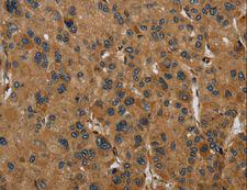 PAEP / Glycodelin / GdF Antibody - Immunohistochemistry of paraffin-embedded Human liver cancer using PAEP Polyclonal Antibody at dilution of 1:60.
