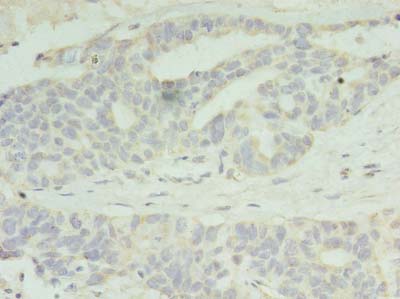 PAFAH1B2 Antibody - Immunohistochemistry of paraffin-embedded human endometrial cancer using antibody at dilution of 1:100.