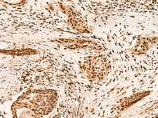 PAFAH1B2 Antibody - Immunohistochemistry of paraffin-embedded Human esophagus cancer tissue  using PAFAH1B2 Polyclonal Antibody at dilution of 1:60(×200)