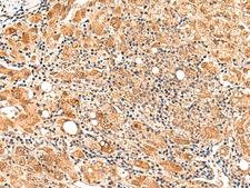 PAFAH1B2 Antibody - Immunohistochemistry of paraffin-embedded Human liver cancer tissue  using PAFAH1B2 Polyclonal Antibody at dilution of 1:50(×200)