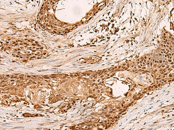 PAFAH1B2 Antibody - Immunohistochemistry of paraffin-embedded Human esophagus cancer tissue  using PAFAH1B2 Polyclonal Antibody at dilution of 1:50(×200)