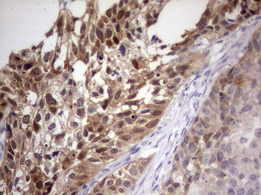 PAFAH1B3 Antibody - IHC of paraffin-embedded Carcinoma of Human kidney tissue using anti-PAFAH1B3 mouse monoclonal antibody. (Heat-induced epitope retrieval by 1 mM EDTA in 10mM Tris, pH8.5, 120°C for 3min).