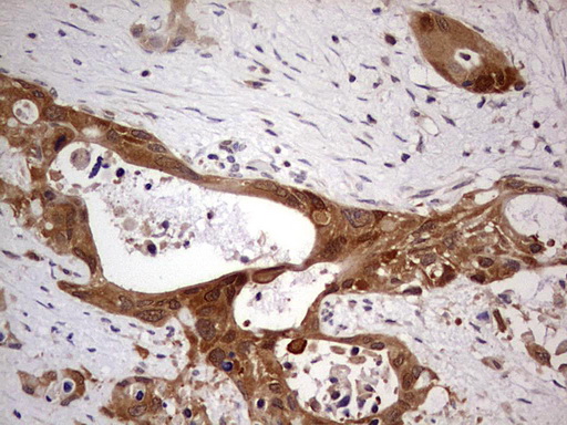 PAFAH1B3 Antibody - Immunohistochemical staining of paraffin-embedded Carcinoma of Human pancreas tissue using anti-PAFAH1B3 mouse monoclonal antibody.  Dilution: 1:150