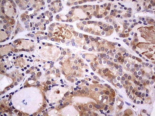 PAFAH1B3 Antibody - Immunohistochemical staining of paraffin-embedded Carcinoma of Human thyroid tissue using anti-PAFAH1B3 mouse monoclonal antibody.  Dilution: 1:150