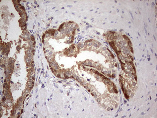 PAFAH1B3 Antibody - Immunohistochemical staining of paraffin-embedded Carcinoma of Human prostate tissue using anti-PAFAH1B3 mouse monoclonal antibody.  Dilution: 1:150