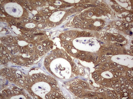 PAFAH1B3 Antibody - Immunohistochemical staining of paraffin-embedded Adenocarcinoma of Human colon tissue using anti-PAFAH1B3 mouse monoclonal antibody.  Dilution: 1:150