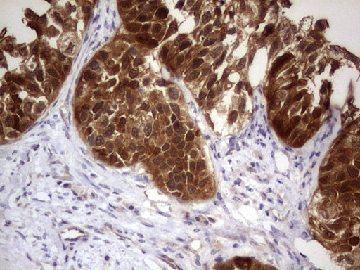 PAFAH1B3 Antibody - Immunohistochemical staining of paraffin-embedded Carcinoma of Human kidney tissue using anti-PAFAH1B3 mouse monoclonal antibody.  Dilution: 1:150