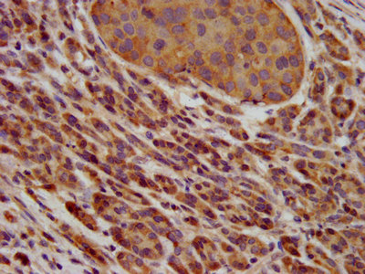 PAFAH1B3 Antibody - Immunohistochemistry image at a dilution of 1:600 and staining in paraffin-embedded human pancreatic cancer performed on a Leica BondTM system. After dewaxing and hydration, antigen retrieval was mediated by high pressure in a citrate buffer (pH 6.0) . Section was blocked with 10% normal goat serum 30min at RT. Then primary antibody (1% BSA) was incubated at 4 °C overnight. The primary is detected by a biotinylated secondary antibody and visualized using an HRP conjugated SP system.