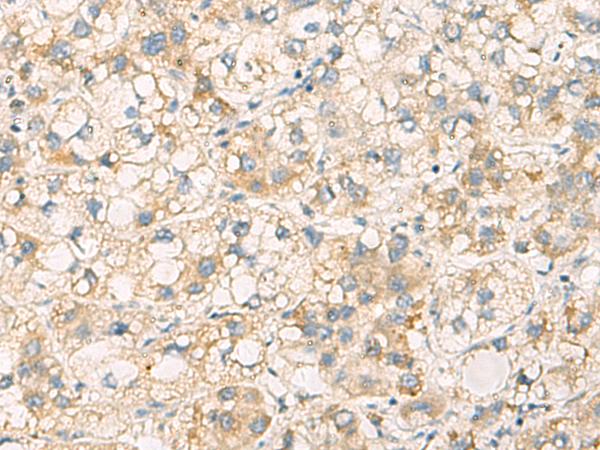 PAFAH1B3 Antibody - Immunohistochemistry of paraffin-embedded Human liver cancer tissue  using PAFAH1B3 Polyclonal Antibody at dilution of 1:70(×200)