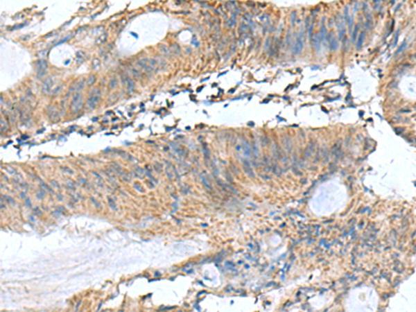 PAFAH1B3 Antibody - Immunohistochemistry of paraffin-embedded Human colorectal cancer tissue  using PAFAH1B3 Polyclonal Antibody at dilution of 1:60(×200)