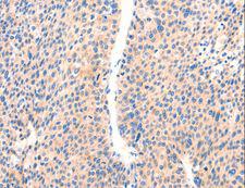 PAFAH2 Antibody - Immunohistochemistry of paraffin-embedded Human liver cancer using PAFAH2 Polyclonal Antibody at dilution of 1:80.