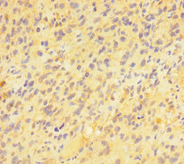 PAG1 Antibody - Immunohistochemistry of paraffin-embedded human glioma cancer at dilution of 1:100
