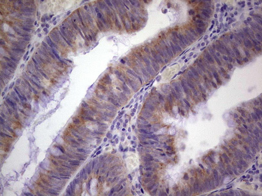 PAGE1 Antibody - Immunohistochemical staining of paraffin-embedded Adenocarcinoma of Human colon tissue using anti-PAGE1 mouse monoclonal antibody. (Heat-induced epitope retrieval by 1 mM EDTA in 10mM Tris, pH8.5, 120C for 3min,