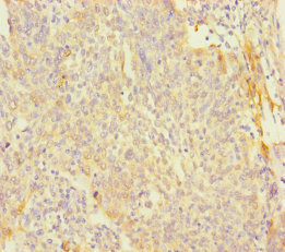 PAGE2B Antibody - Immunohistochemistry of paraffin-embedded human cervical cancer using PAGE2B Antibody at dilution of 1:100
