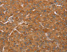 PAGE5 Antibody - Immunohistochemistry of paraffin-embedded Human liver cancer using PAGE5 Polyclonal Antibody at dilution of 1:55.