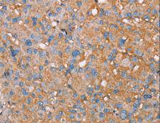 PAGE5 Antibody - Immunohistochemistry of paraffin-embedded Human liver cancer using PAGE5 Polyclonal Antibody at dilution of 1:55.