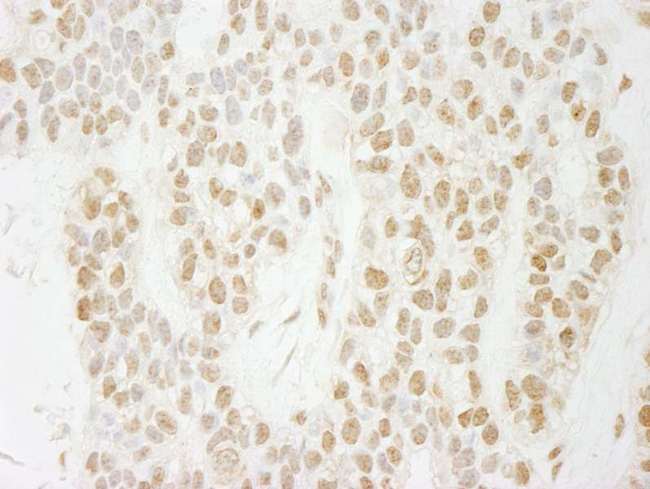 PAGR1 / C16orf53 Antibody - Detection of Human PA1 by Immunohistochemistry. Sample: FFPE section of human breast carcinoma. Antibody: Affinity purified rabbit anti-PA1 used at a dilution of 1:250.