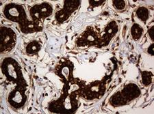 PAI-RBP1 / SERBP1 Antibody - IHC of paraffin-embedded Human breast tissue using anti-SERBP1 mouse monoclonal antibody. (Heat-induced epitope retrieval by 10mM citric buffer, pH6.0, 120°C for 3min).