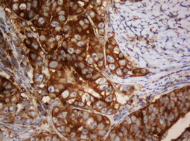 PAI-RBP1 / SERBP1 Antibody - IHC of paraffin-embedded Adenocarcinoma of Human colon tissue using anti-SERBP1 mouse monoclonal antibody. (Heat-induced epitope retrieval by 10mM citric buffer, pH6.0, 120°C for 3min).