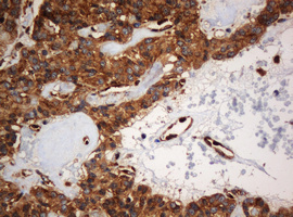 PAI-RBP1 / SERBP1 Antibody - IHC of paraffin-embedded Carcinoma of Human pancreas tissue using anti-SERBP1 mouse monoclonal antibody. (Heat-induced epitope retrieval by 10mM citric buffer, pH6.0, 120°C for 3min).