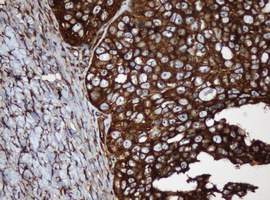 PAI-RBP1 / SERBP1 Antibody - IHC of paraffin-embedded Adenocarcinoma of Human ovary tissue using anti-SERBP1 mouse monoclonal antibody. (Heat-induced epitope retrieval by 10mM citric buffer, pH6.0, 120°C for 3min).