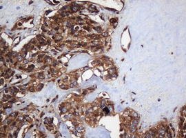 PAI-RBP1 / SERBP1 Antibody - IHC of paraffin-embedded Carcinoma of Human pancreas tissue using anti-SERBP1 mouse monoclonal antibody. (Heat-induced epitope retrieval by 10mM citric buffer, pH6.0, 120°C for 3min).