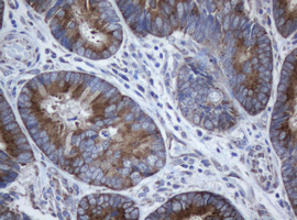 PAI-RBP1 / SERBP1 Antibody - IHC of paraffin-embedded Adenocarcinoma of Human colon tissue using anti-SERBP1 mouse monoclonal antibody.