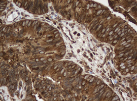 PAI-RBP1 / SERBP1 Antibody - IHC of paraffin-embedded Adenocarcinoma of Human colon tissue using anti-SERBP1 mouse monoclonal antibody.