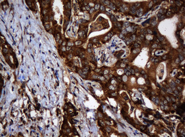 PAI-RBP1 / SERBP1 Antibody - IHC of paraffin-embedded Carcinoma of Human liver tissue using anti-SERBP1 mouse monoclonal antibody.