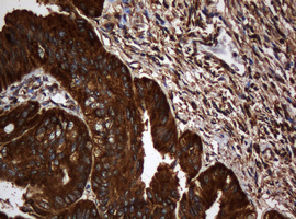 PAI-RBP1 / SERBP1 Antibody - IHC of paraffin-embedded Adenocarcinoma of Human endometrium tissue using anti-SERBP1 mouse monoclonal antibody.
