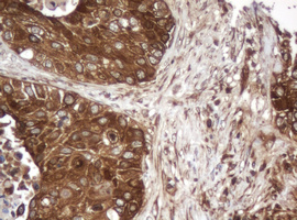PAI-RBP1 / SERBP1 Antibody - IHC of paraffin-embedded Carcinoma of Human lung tissue using anti-SERBP1 mouse monoclonal antibody.