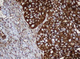 PAI-RBP1 / SERBP1 Antibody - IHC of paraffin-embedded Adenocarcinoma of Human ovary tissue using anti-SERBP1 mouse monoclonal antibody.