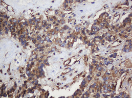 PAI-RBP1 / SERBP1 Antibody - IHC of paraffin-embedded Carcinoma of Human pancreas tissue using anti-SERBP1 mouse monoclonal antibody.