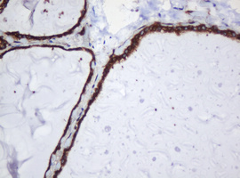 PAI-RBP1 / SERBP1 Antibody - IHC of paraffin-embedded Human thyroid tissue using anti-SERBP1 mouse monoclonal antibody.