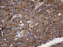 PAI-RBP1 / SERBP1 Antibody - IHC of paraffin-embedded Carcinoma of Human thyroid tissue using anti-SERBP1 mouse monoclonal antibody.