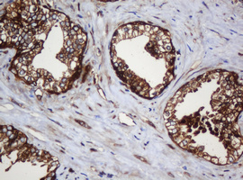PAI-RBP1 / SERBP1 Antibody - IHC of paraffin-embedded Carcinoma of Human prostate tissue using anti-SERBP1 mouse monoclonal antibody.