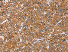 PAICS / ADE2 Antibody - Immunohistochemistry of paraffin-embedded Human liver cancer using PAICS Polyclonal Antibody at dilution of 1:35.