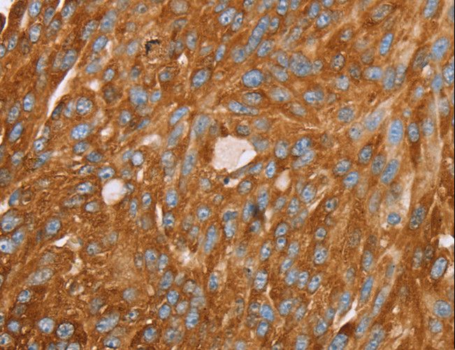 PAICS / ADE2 Antibody - Immunohistochemistry of paraffin-embedded Human breast cancer using PAICS Polyclonal Antibody at dilution of 1:35.