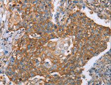 PAICS / ADE2 Antibody - Immunohistochemistry of paraffin-embedded Human cervical cancer using PAICS Polyclonal Antibody at dilution of 1:50.
