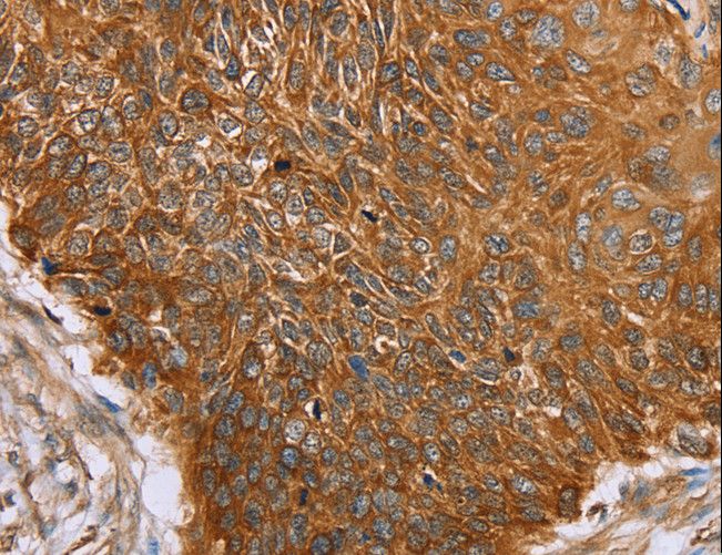 PAICS / ADE2 Antibody - Immunohistochemistry of paraffin-embedded Human esophagus cancer using PAICS Polyclonal Antibody at dilution of 1:50.