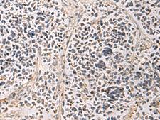 PAIP1 Antibody - Immunohistochemistry of paraffin-embedded Human breast cancer tissue  using PAIP1 Polyclonal Antibody at dilution of 1:80(×200)