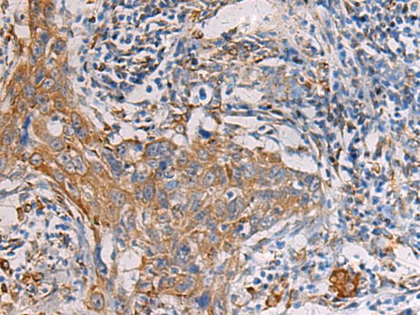 PAIP1 Antibody - Immunohistochemistry of paraffin-embedded Human esophagus cancer tissue  using PAIP1 Polyclonal Antibody at dilution of 1:60(×200)