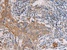 PAIP1 Antibody - Immunohistochemistry of paraffin-embedded Human esophagus cancer tissue  using PAIP1 Polyclonal Antibody at dilution of 1:60(×200)
