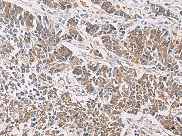PAIP1 Antibody - Immunohistochemistry of paraffin-embedded Human colorectal cancer tissue  using PAIP1 Polyclonal Antibody at dilution of 1:60(×200)