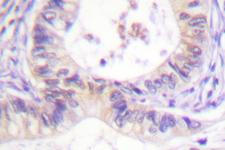 PAK1 Antibody - IHC of PAK1 (I206) pAb in paraffin-embedded human colon carcinoma tissue.