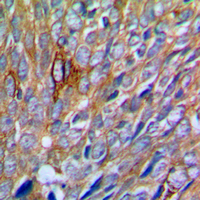 PAK1 Antibody - Immunohistochemical analysis of PAK1 staining in human prostate cancer formalin fixed paraffin embedded tissue section. The section was pre-treated using heat mediated antigen retrieval with sodium citrate buffer (pH 6.0). The section was then incubated with the antibody at room temperature and detected using an HRP conjugated compact polymer system. DAB was used as the chromogen. The section was then counterstained with hematoxylin and mounted with DPX.