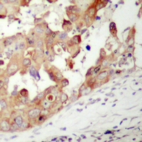 PAK1 Antibody - Immunohistochemical analysis of PAK1 staining in human prostate cancer formalin fixed paraffin embedded tissue section. The section was pre-treated using heat mediated antigen retrieval with sodium citrate buffer (pH 6.0). The section was then incubated with the antibody at room temperature and detected using an HRP polymer system. DAB was used as the chromogen. The section was then counterstained with hematoxylin and mounted with DPX.