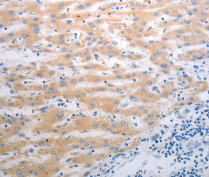 PAK1 Antibody - Immunohistochemistry of paraffin-embedded human liver cancer tissue.